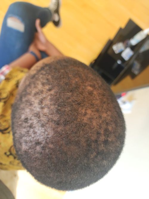 Face skin before treatment